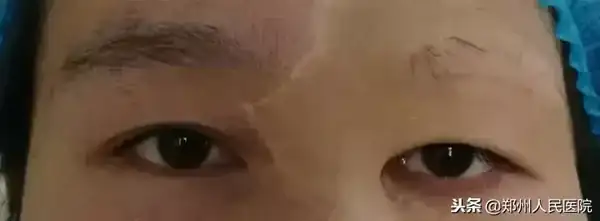 割雙眼皮鄭州醫院_鄭州雙眼皮手術_鄭州割雙眼皮好的醫生