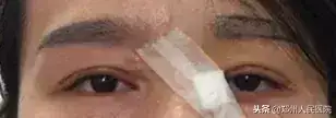 鄭州割雙眼皮好的醫生_割雙眼皮鄭州醫院_鄭州雙眼皮手術