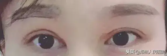 鄭州割雙眼皮好的醫生_割雙眼皮鄭州醫院_鄭州雙眼皮手術