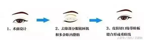 鄭州排名第一的割雙眼皮醫生_鄭州割雙眼皮醫生排行榜前十名_鄭州割雙眼皮好的醫生