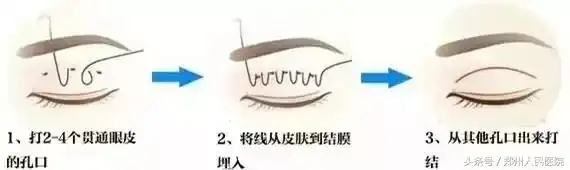 鄭州割雙眼皮好的醫生_鄭州割雙眼皮醫生排行榜前十名_鄭州排名第一的割雙眼皮醫生