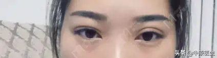 鄭州排名第一的割雙眼皮醫生_鄭州割雙眼皮好的醫生_鄭州割雙眼皮醫生排行榜前十名