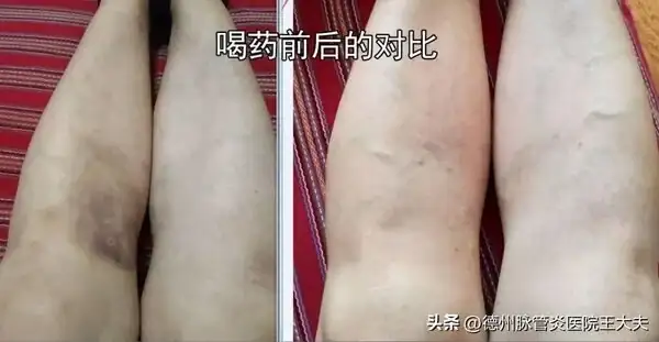 中醫治療靜脈炎：獨特優勢助您擺脫困擾