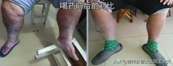 脈管炎治療的最好方法_怎麼治好脈管炎_治療方法好脈管炎的藥物
