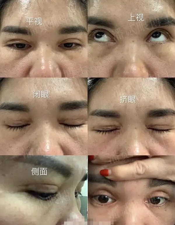 女子衝動割雙眼皮，未與醫師溝通導致歐式平行效果，你是否也有類似經驗？