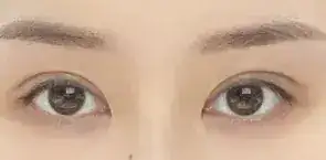 雙眼皮修復廣州哪個醫院好_廣州雙眼皮修復專家排名_廣州雙眼皮手術修復