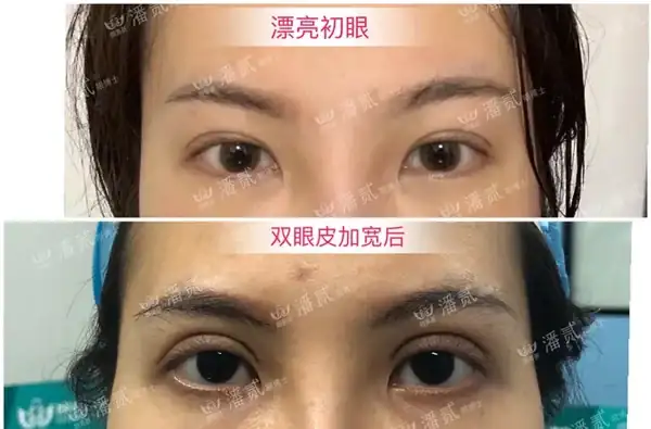 雙眼皮寬度並非越寬越好，適合自己才是關鍵