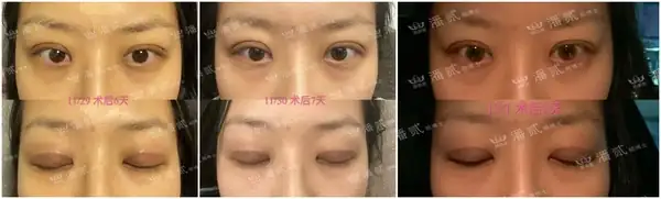 廣州雙眼皮手術修復_廣州十大雙眼皮修復醫生_廣州雙眼皮修復吧{搜}