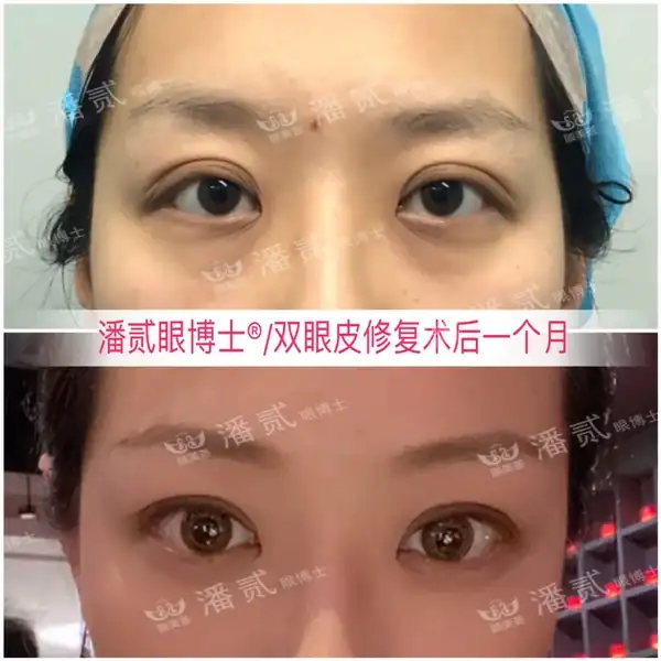 廣州雙眼皮手術修復_廣州十大雙眼皮修復醫生_廣州雙眼皮修復吧{搜}