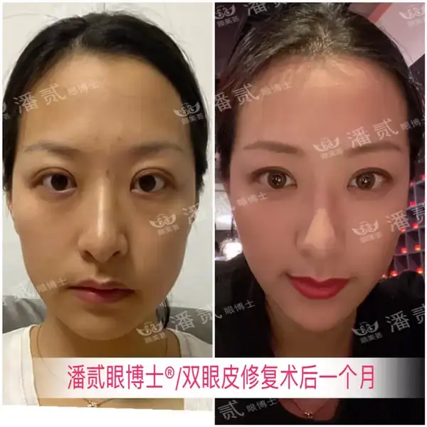 廣州十大雙眼皮修復醫生_廣州雙眼皮手術修復_廣州雙眼皮修復吧{搜}