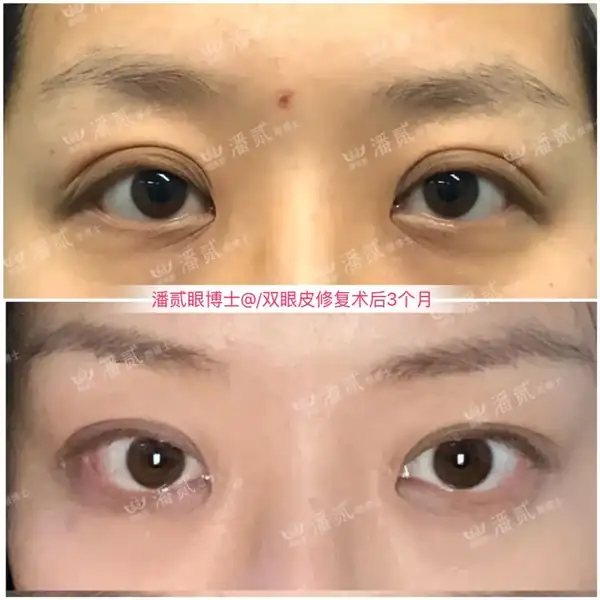 廣州雙眼皮修復吧{搜} _廣州雙眼皮手術修復_廣州十大雙眼皮修復醫生