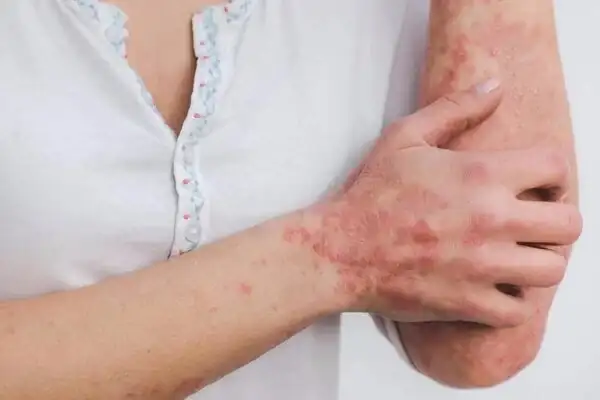 膿包型乾癬能治癒嗎_膿包型乾癬用藥_膿包型乾癬抹什麼藥膏