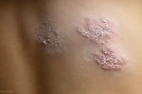 膿包型乾癬用藥_膿包型乾癬抹什麼藥膏_膿包型乾癬能治癒嗎
