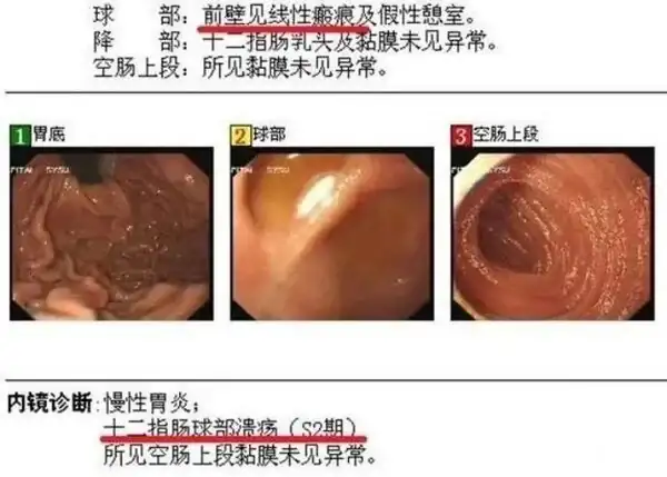 吞了牙籤時候會有反應_牙籤吞下去會有感覺嗎_吞進牙籤