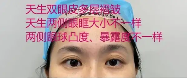 雙眼皮修復廣州_廣州雙眼皮修復吧{搜尋}_廣州雙眼皮手術修復