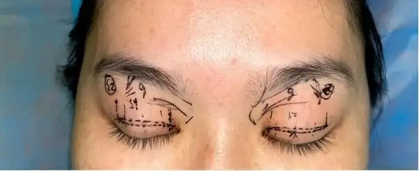 廣州雙眼皮手術修復_廣州雙眼皮修復吧{搜}_雙眼皮修復廣州