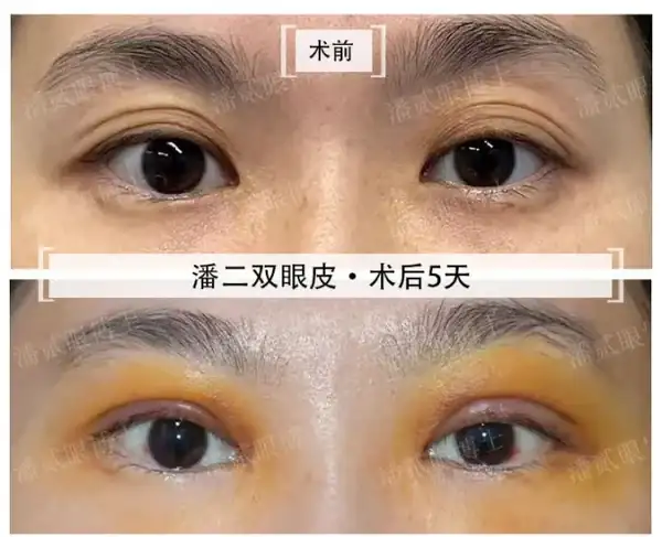 雙眼皮修復廣州_廣州雙眼皮修復吧{搜尋}_廣州雙眼皮手術修復