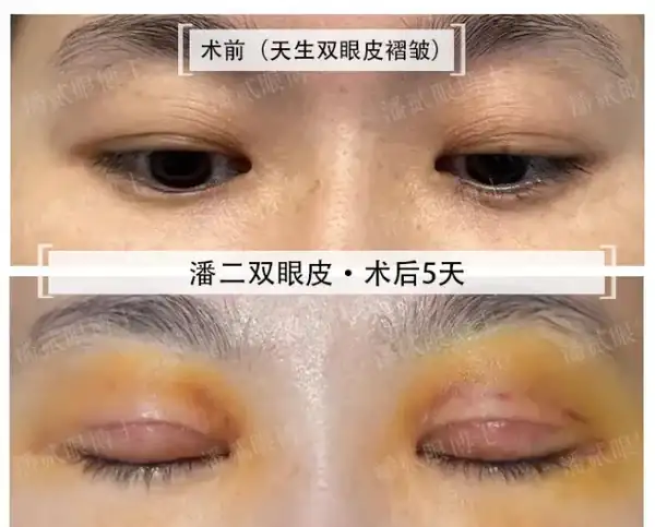 廣州雙眼皮手術修復_廣州雙眼皮修復吧{搜}_雙眼皮修復廣州