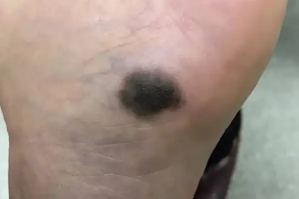 心理疾病會造成手指癢嗎_手指癢會不會肝臟出現問題_手指特別癢是癌症先兆
