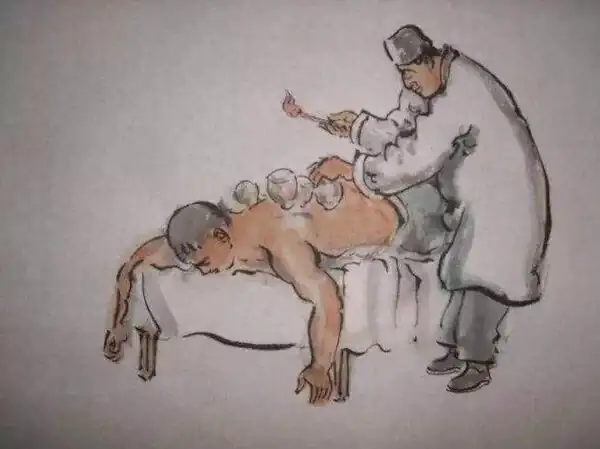 中醫拔罐後注意事項_中醫事項注意拔罐後注意什麼_中醫事項注意拔罐後吃什麼