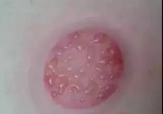中醫事項注意拔罐後吃什麼_中醫事項注意拔罐後注意什麼_中醫拔罐後注意事項