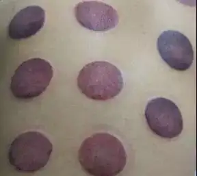中醫事項注意拔罐後注意什麼_中醫事項注意拔罐後吃什麼_中醫拔罐後注意事項