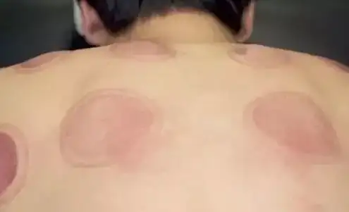 中醫事項注意拔罐後注意什麼_中醫拔罐後注意事項_中醫事項注意拔罐後吃什麼